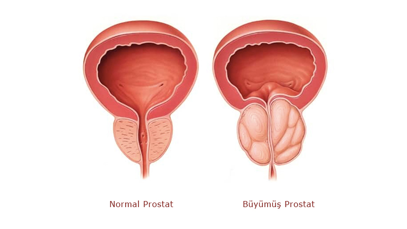 Prostat Büyümesi Nedir?