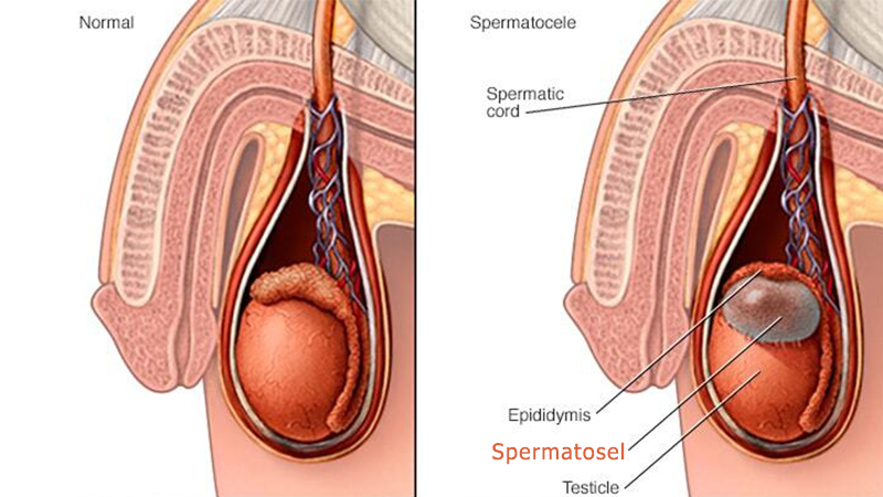 Spermatosel Nedir?