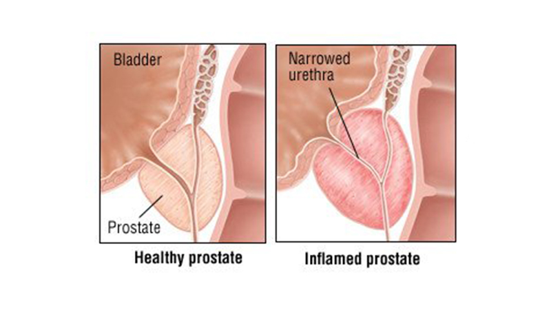 Kronik Prostatit Nedir?